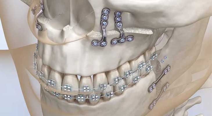 ارتودنسی با جراحی فک