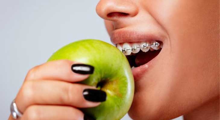 رژیم غذایی در ارتودنسی
