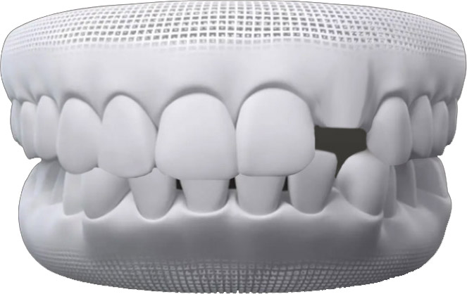 دندان نهفته