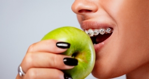 رژیم غذایی در ارتودنسی