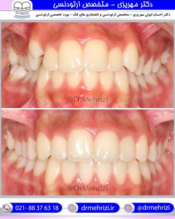 درمان ارتودنسی در کمتر از یک سال