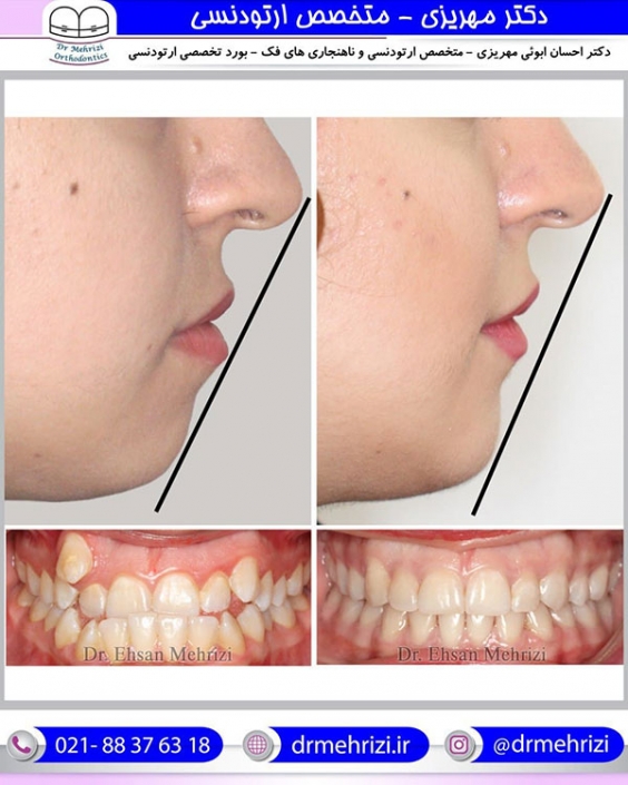 ارتودنسی ثابت دو فک با کشیدن چهار دندان