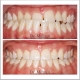 درمان ارتودنسی ثابت دو فک با کشیدن دو دندان