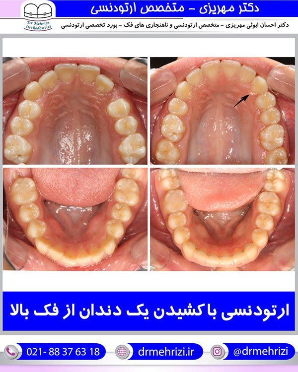  ارتودنسی با کشیدن یک دندان از فک بالا