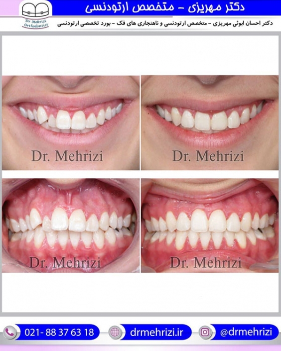 ارتودنسی جلو بودن دندان ها و فک بالا
