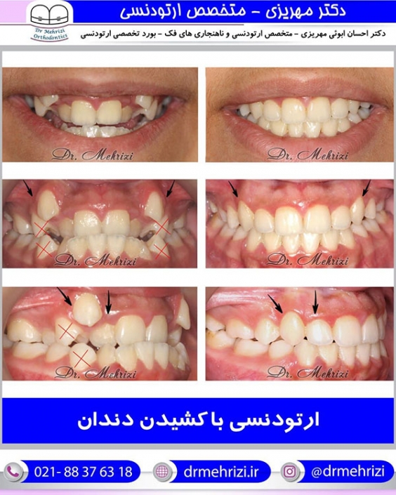 ارتودنسی با کشیدن دندان