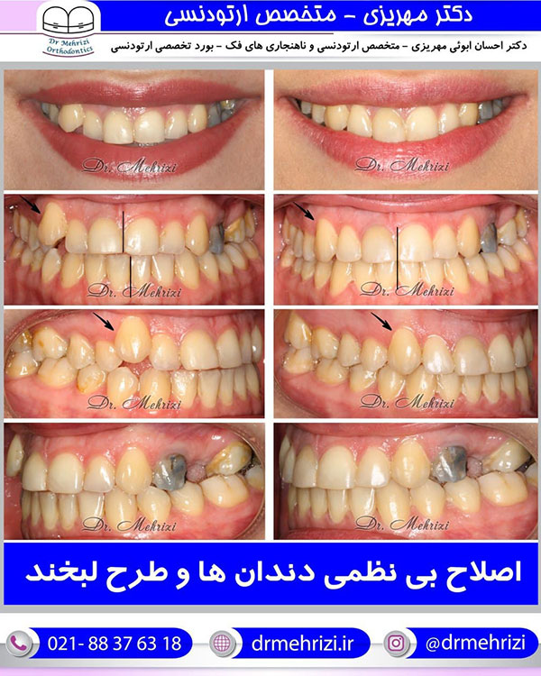 اصلاح بی نظمی دندانها و طرح لبخند