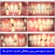 درمان ارتودنسی بهم ریختگی شدید دندان‌ها