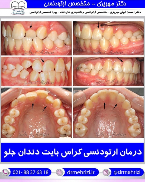 درمان ارتودنسی کراس بایت دندان جلو