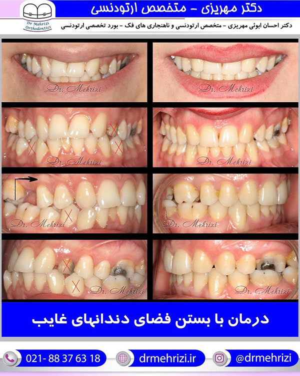 درمان با بستن فضای دندانهای غایب