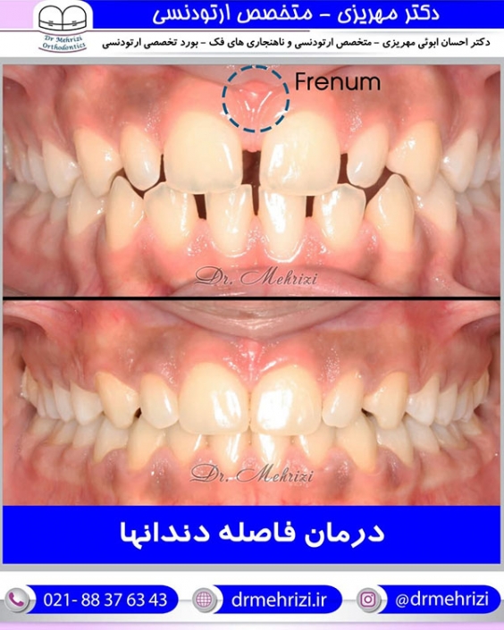 درمان فاصله دندان ها