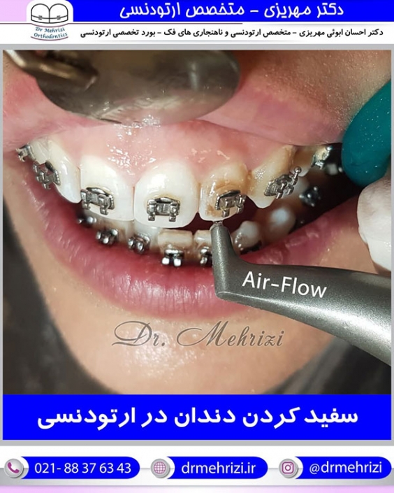 سفید کردن دندان در ارتودنسی