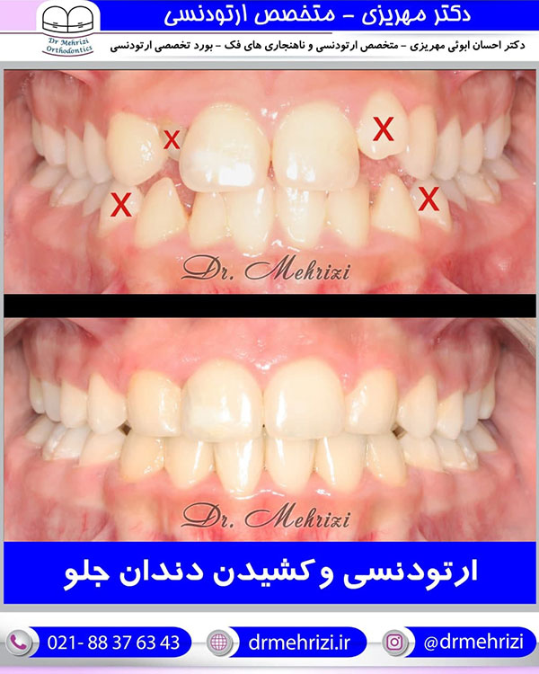 ارتودنسی و کشیدن دندان جلو