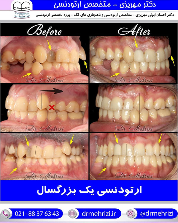 ارتودنسی یک بزرگسال