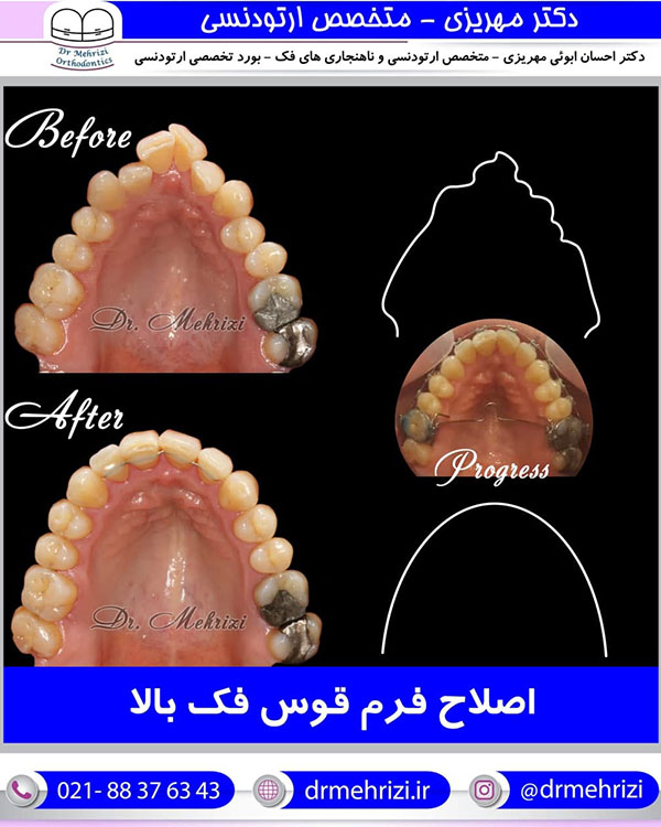 اصلاح فرم قوسهای دندانی