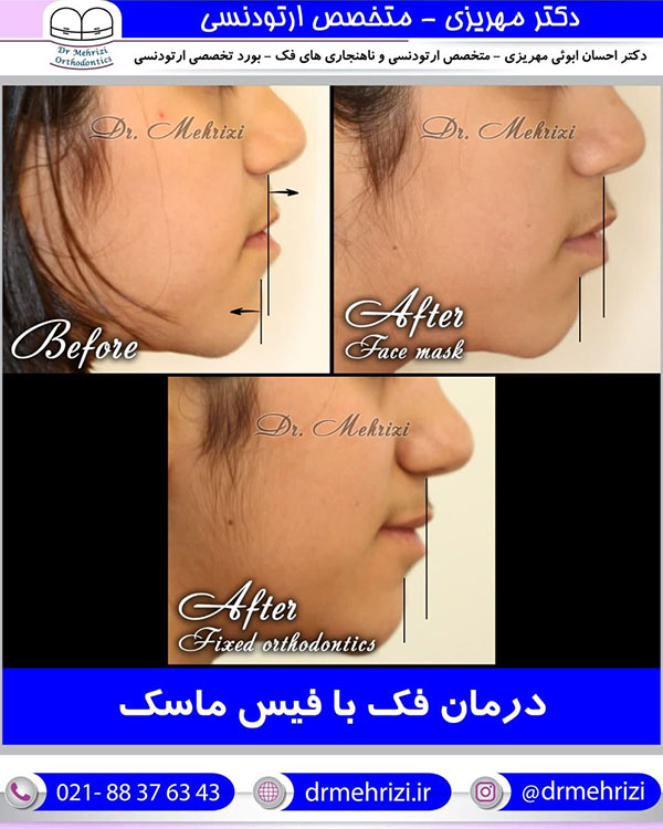 درمان با فیس ماسک