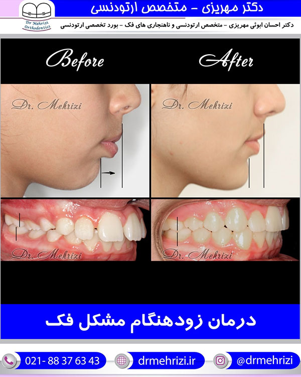 درمان زود هنگام مشکل فک
