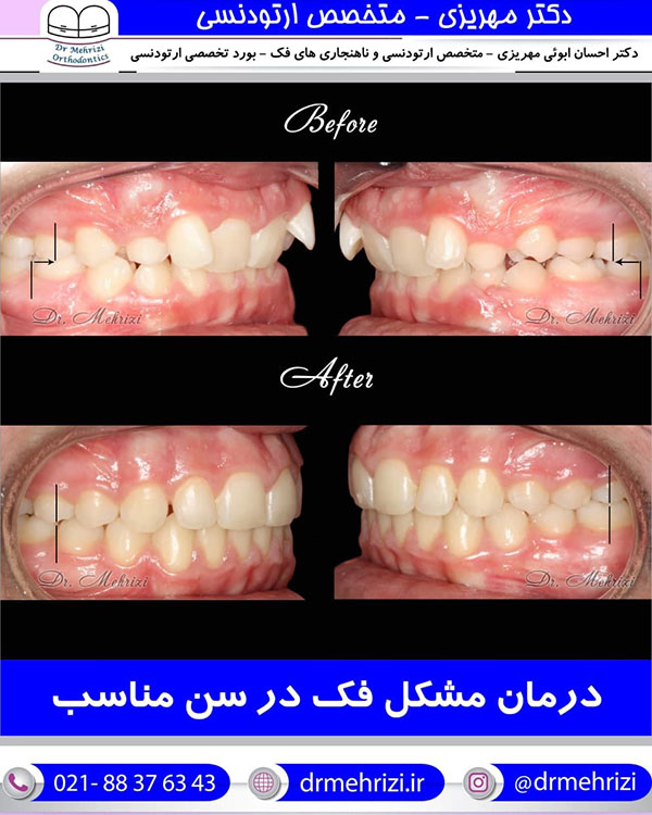 درمان مشکل فک در سن مناسب