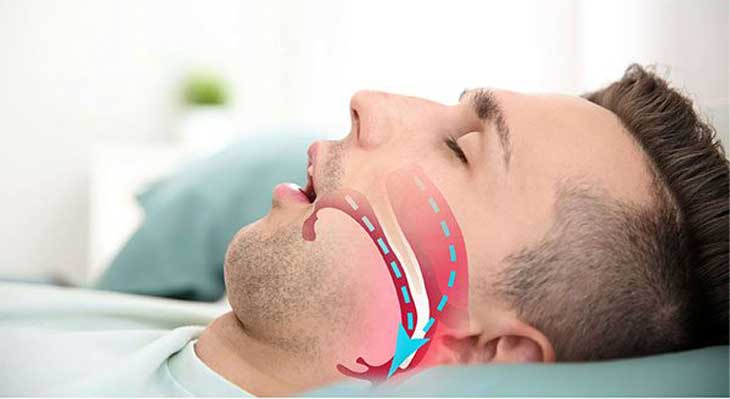 درمان آپنه خواب با ارتودنسی