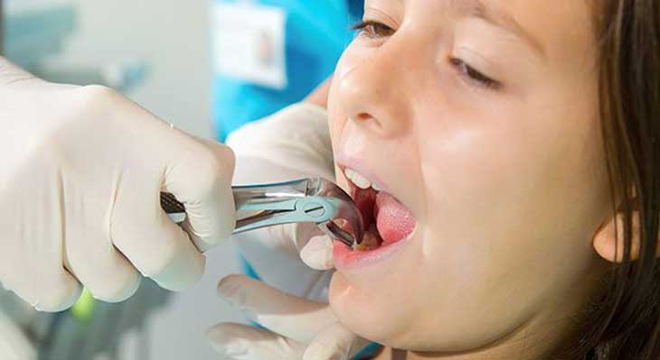 کشیدن دندان عقل برای ارتودنسی