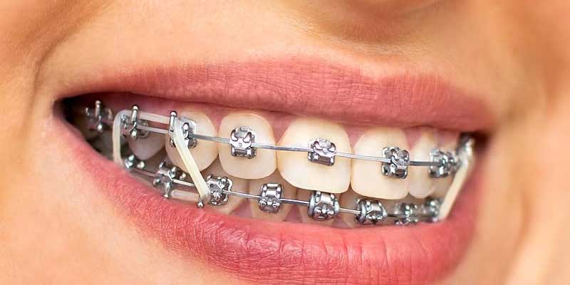 کش ارتودنسی چیست؟