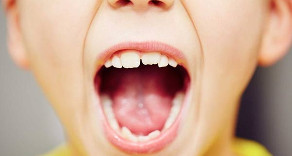 علت کج شدن دندان ها در کودکان