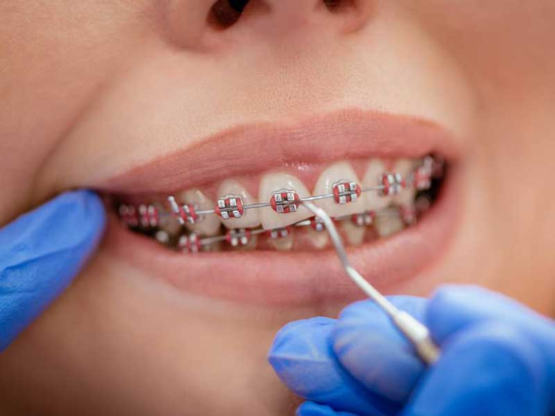 مراقبت های ارتودنسی متحرک