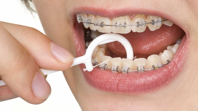 مراقبت های ارتودنسی متحرک