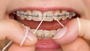 نخ دندان ارتودنسی چیست و چه مزایایی دارد؟