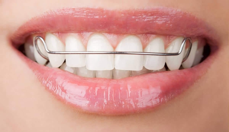 پلاک ارتودنسی چیست؟