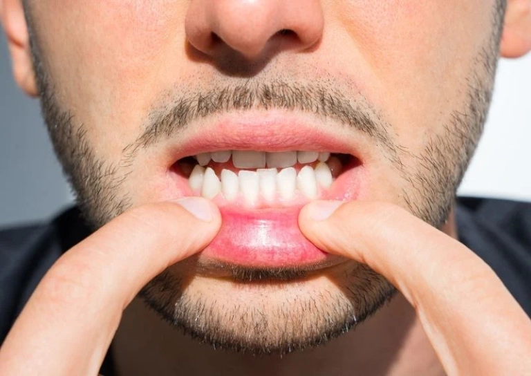 آندربایت چیست