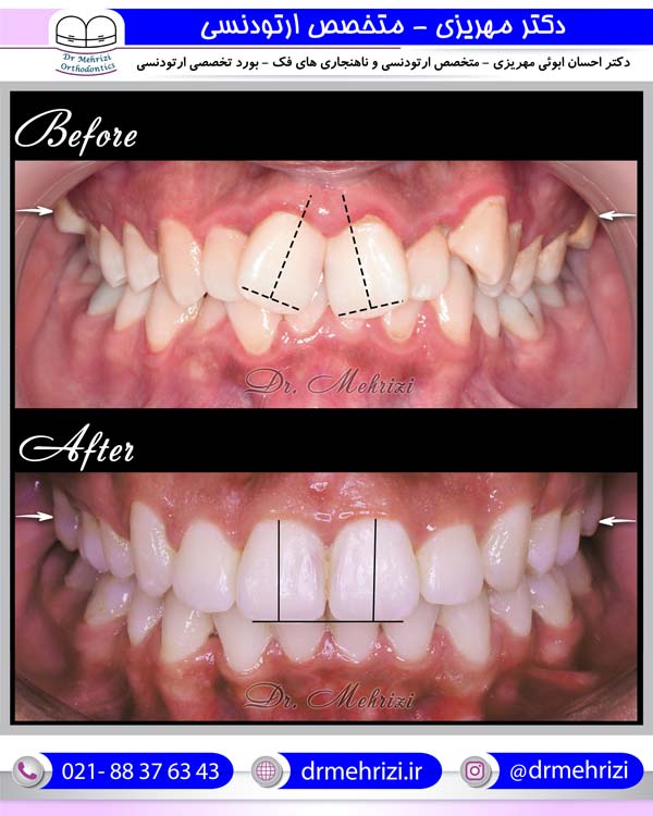 نمونه درمان ارتودنسی ثابت همراه کشیدن چهار دندان آسیاب
