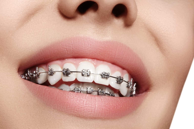 اقدامات قبل از ارتودنسی