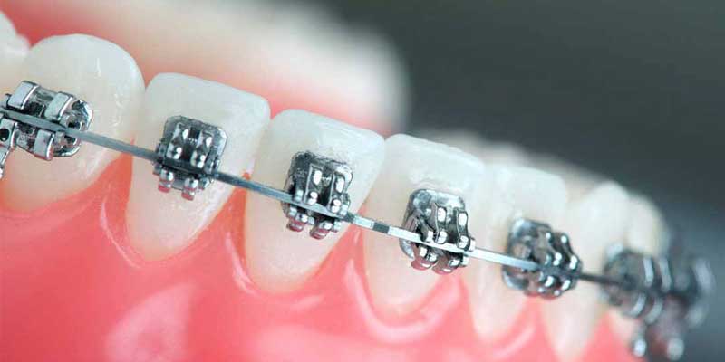تعداد جلسات ارتودنسی چقدر است؟