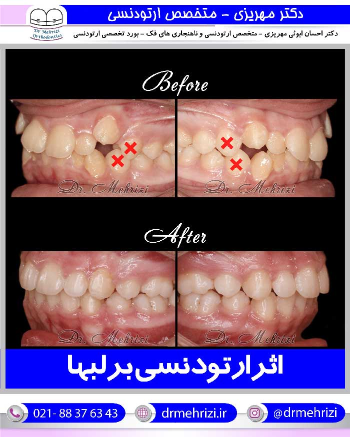 درمان ارتودنسی و تاثیر روی لبها