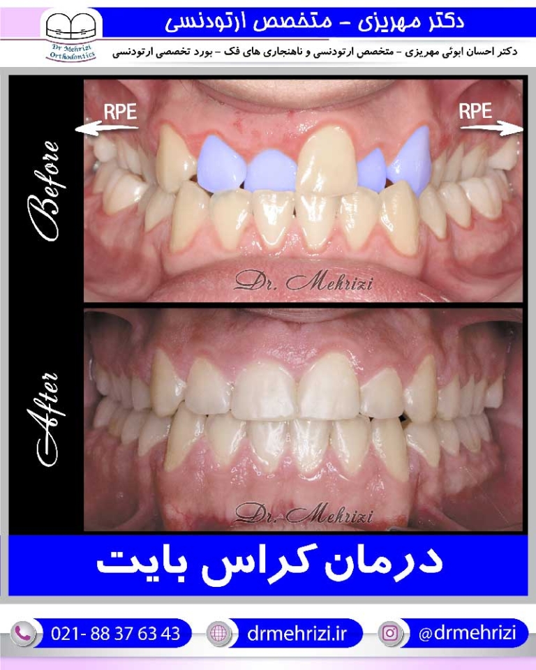 درمان کراس بایت
