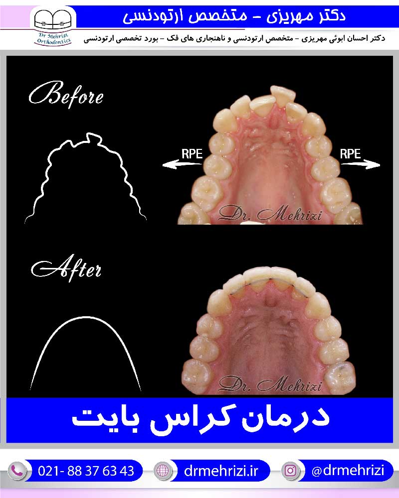 درمان کراس بایت