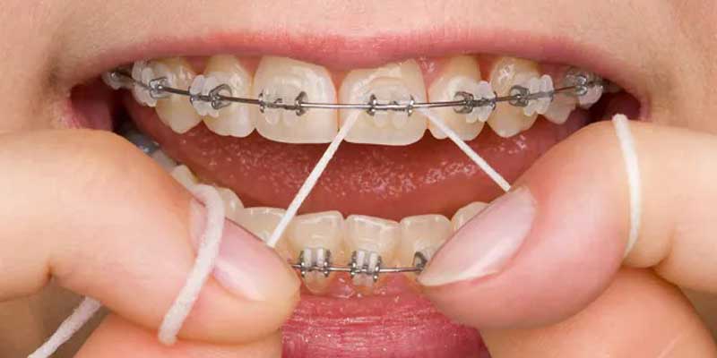 تعداد جلسات ارتودنسی چقدر است؟