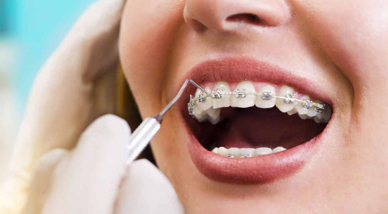 تعداد جلسات ارتودنسی