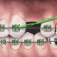 کشیدن دندان برای ارتودنسی