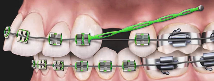 کشیدن دندان برای ارتودنسی