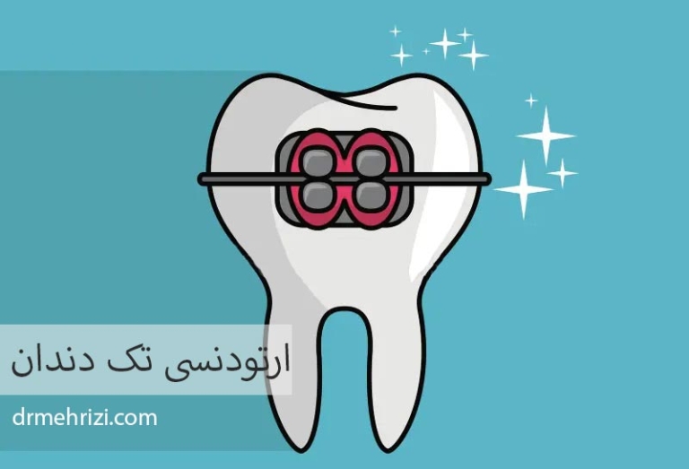 ارتودنسی تک دندان