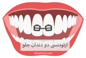 ارتودنسی دو دندان جلو