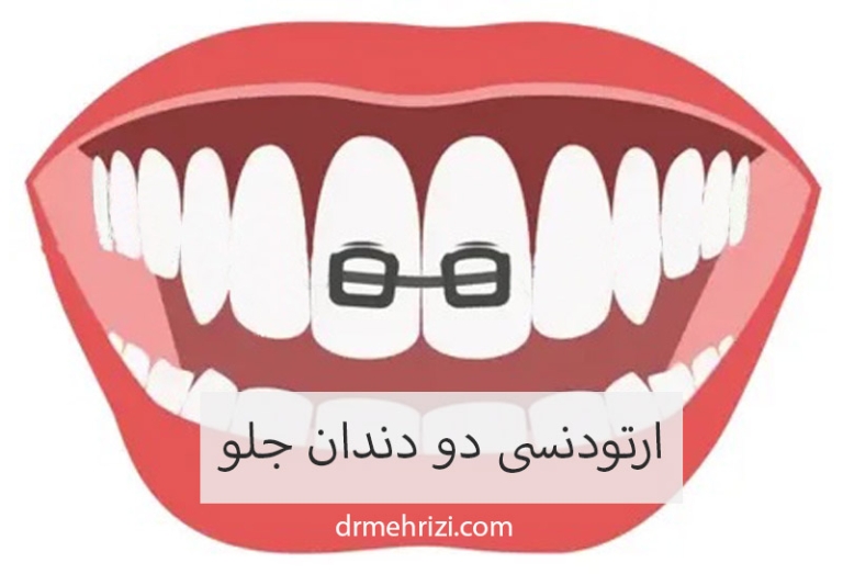 ارتودنسی دو دندان جلو