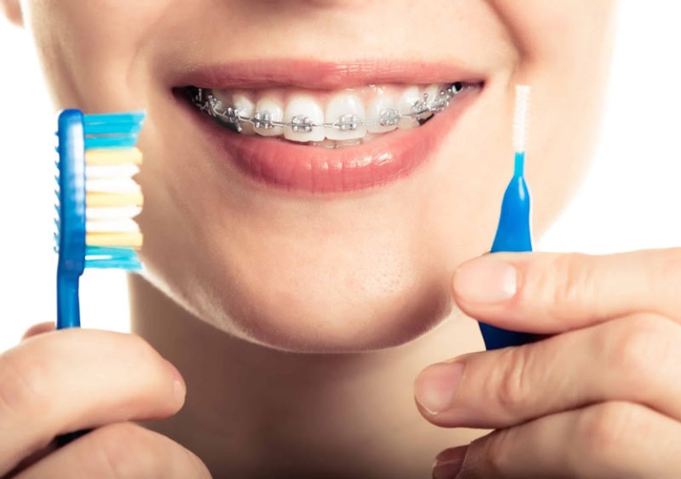 تمیز کردن براکت های ارتودنسی