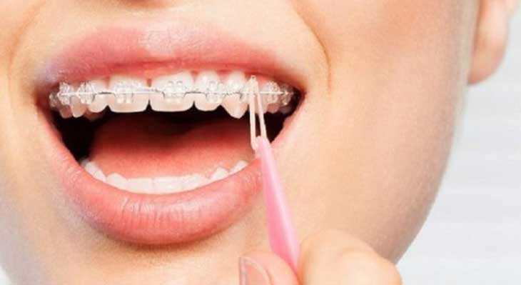 کاهش طول درمان ارتودنسی