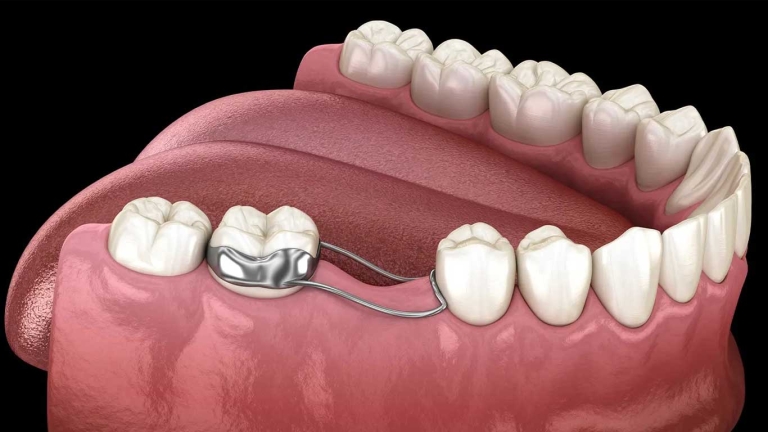 فضا نگهدار ارتودنسی