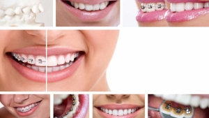 براکت ها چگونه کار می کنند؟