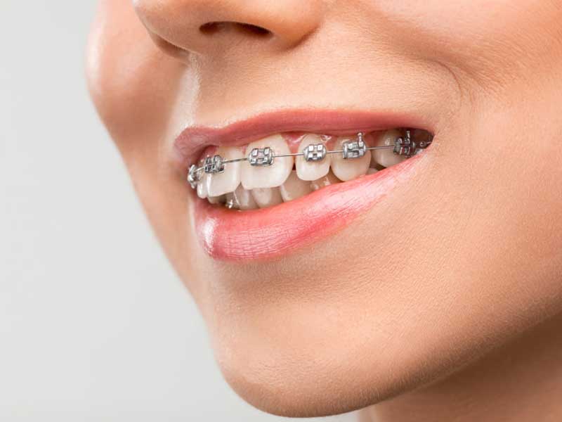 براکت ها چگونه کار می کنند؟