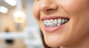 ارتودنسی دندان لمینت شده